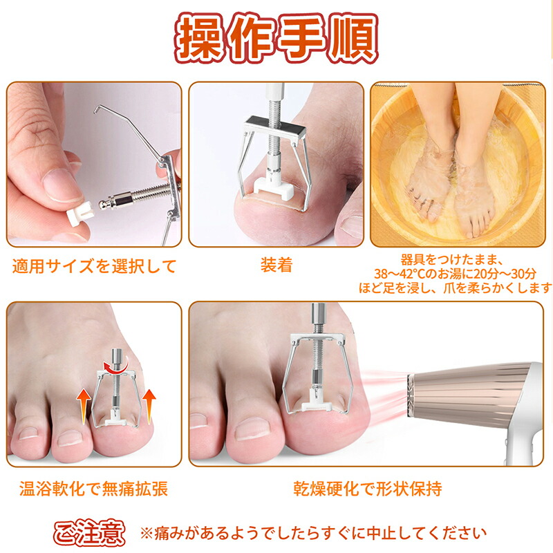 楽天市場】巻き爪 矯正 セット サポート 器具 【20分だけ改善